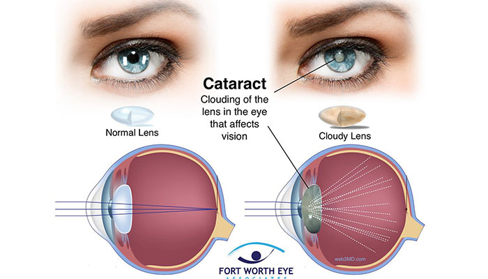 Eye Care Service